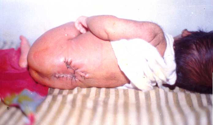 Meningocele Lumbosacral